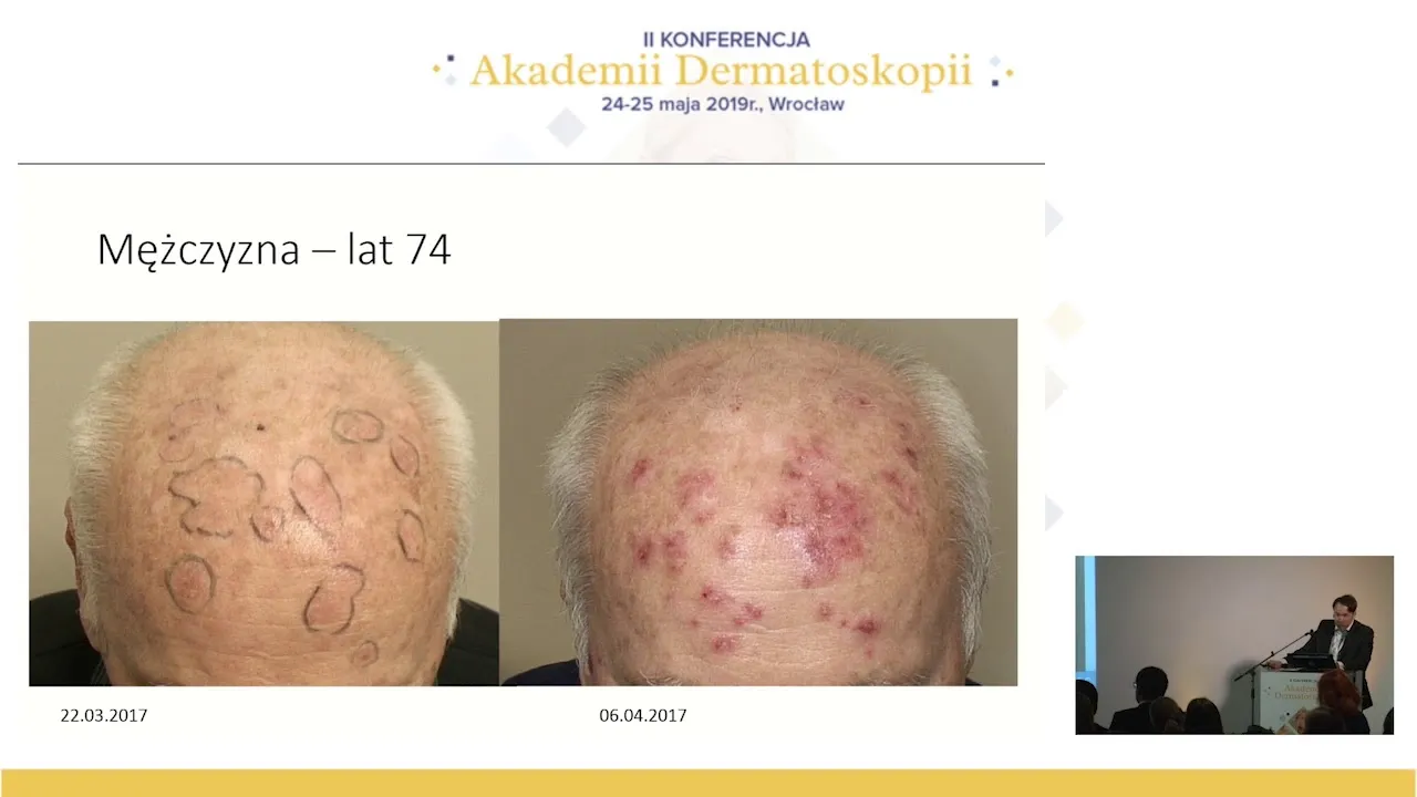 dr n. med. Jacek Calik – Rogowacenie Słoneczne od diagnostyki do leczenia
